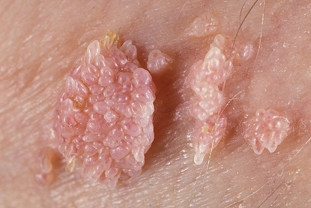 Vacina contra HPV segue disponível